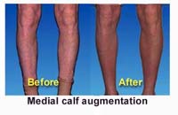 Calf Augmentation
