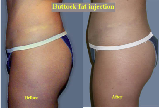 Fat injections