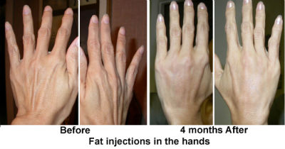 Fat Injections Hand